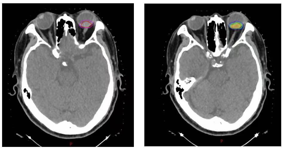 Abstract proton therapy planning screen with skull-base anatomy and organ-at-risk contour cues